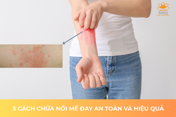 5 Cách Chữa Nổi Mề Đay An Toàn Và Hiệu Quả 
